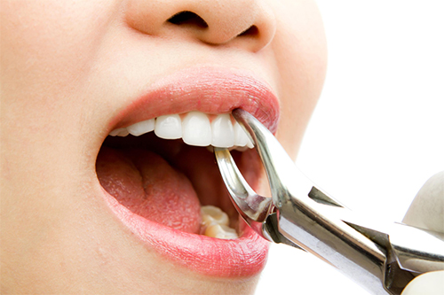 Лечение и удаление зубов: Виды процедур
