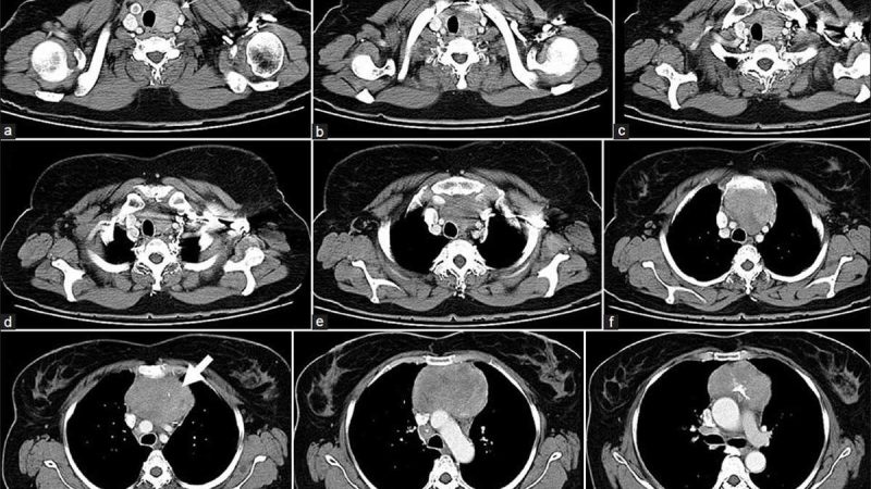Компьютерная томография органов грудной клетки: сущность, методика и преимущества